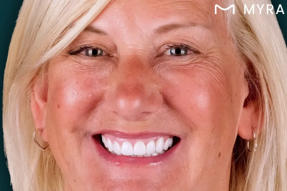 gummy-smile-sonrasi.webp