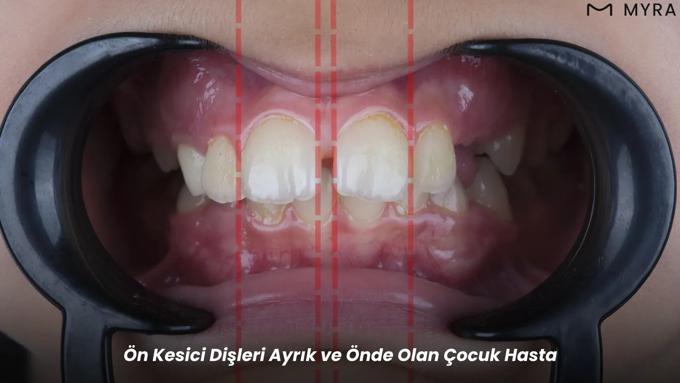Ortodontik tedaviye ihtiyaç duyan çapraşık diş yapısına sahip bir hastanın ağız içi görüntüsü