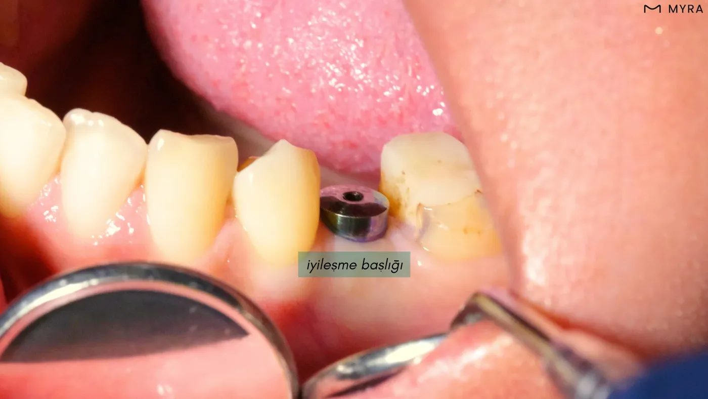 healing-abutment.webp