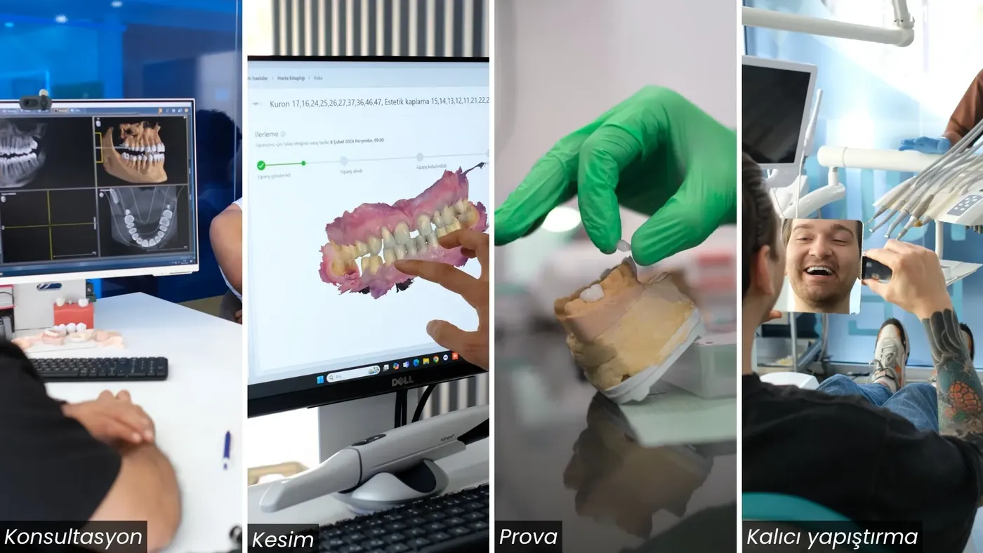Hollywood Smile tedavi süreci adımları