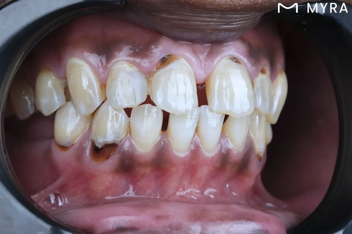 Diş eti çekilmesi ve kemik kaybı gösteren şiddetli periodontitis