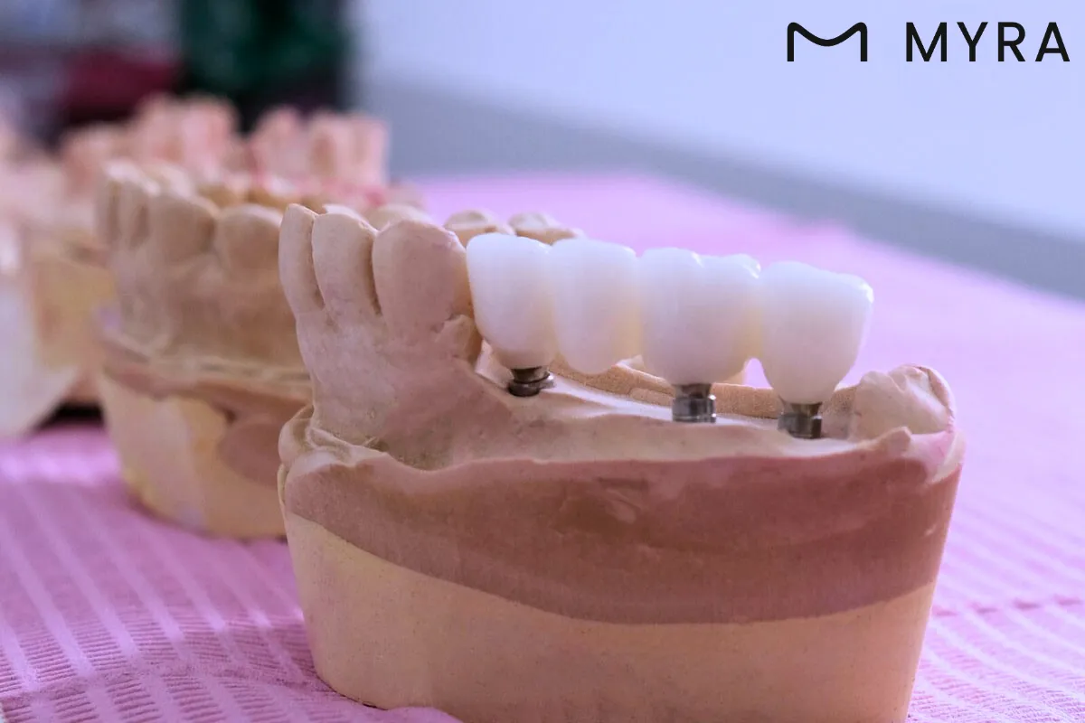 Model üstünde yerleştirilmiş çoklu implant protez örneği