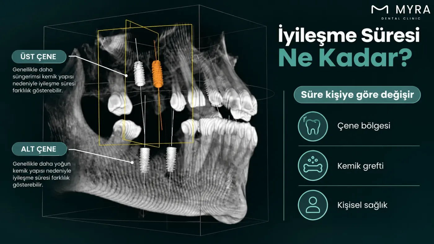 Alt ve üst çenede implant iyileşme sürelerinin farkını gösteren karşılaştırma görseli