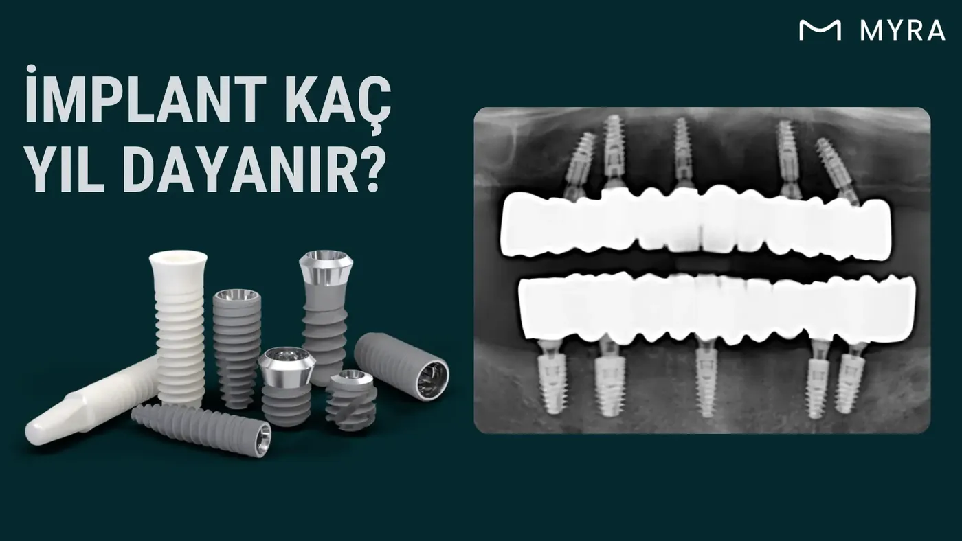 Uzun yıllardır ağızda bulunan sağlıklı dental implantın çene kemiği içindeki görünümü
