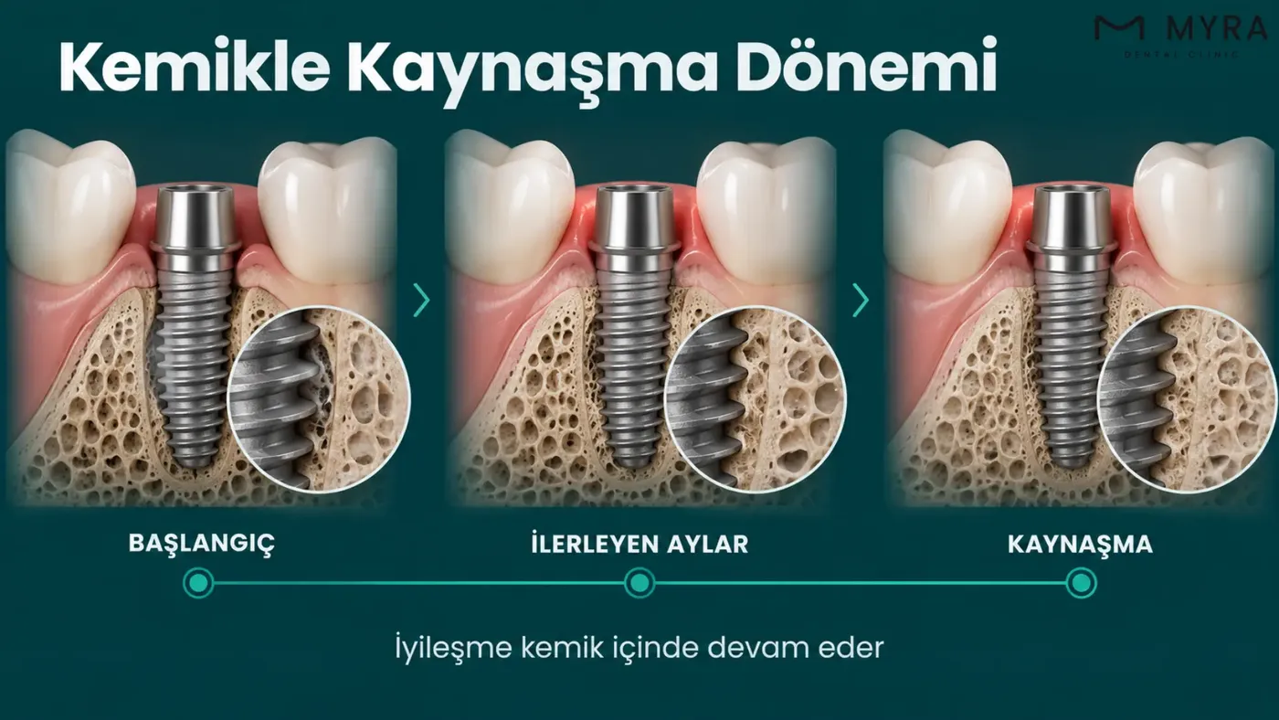 İmplantın çene kemiğiyle kaynaşmasının aylara göre ilerleyişini gösteren takvim görseli
