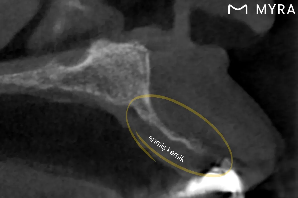  İmplant öncesinde çene kemiğinde erimeyi gösteren tomografi görüntüsü