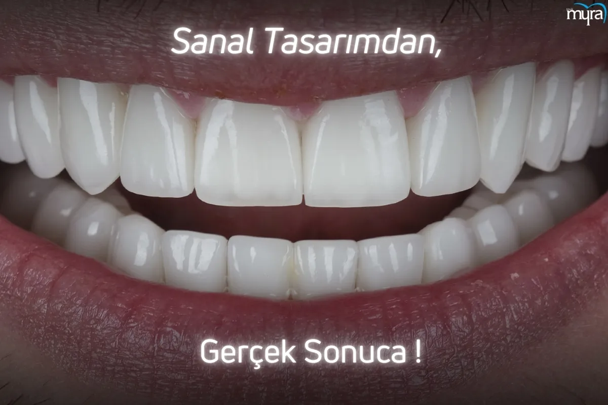 implant-sonrasi-saglikli-dis.webp