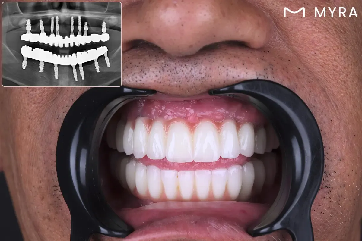 implant-yapilmis-agiz.webp