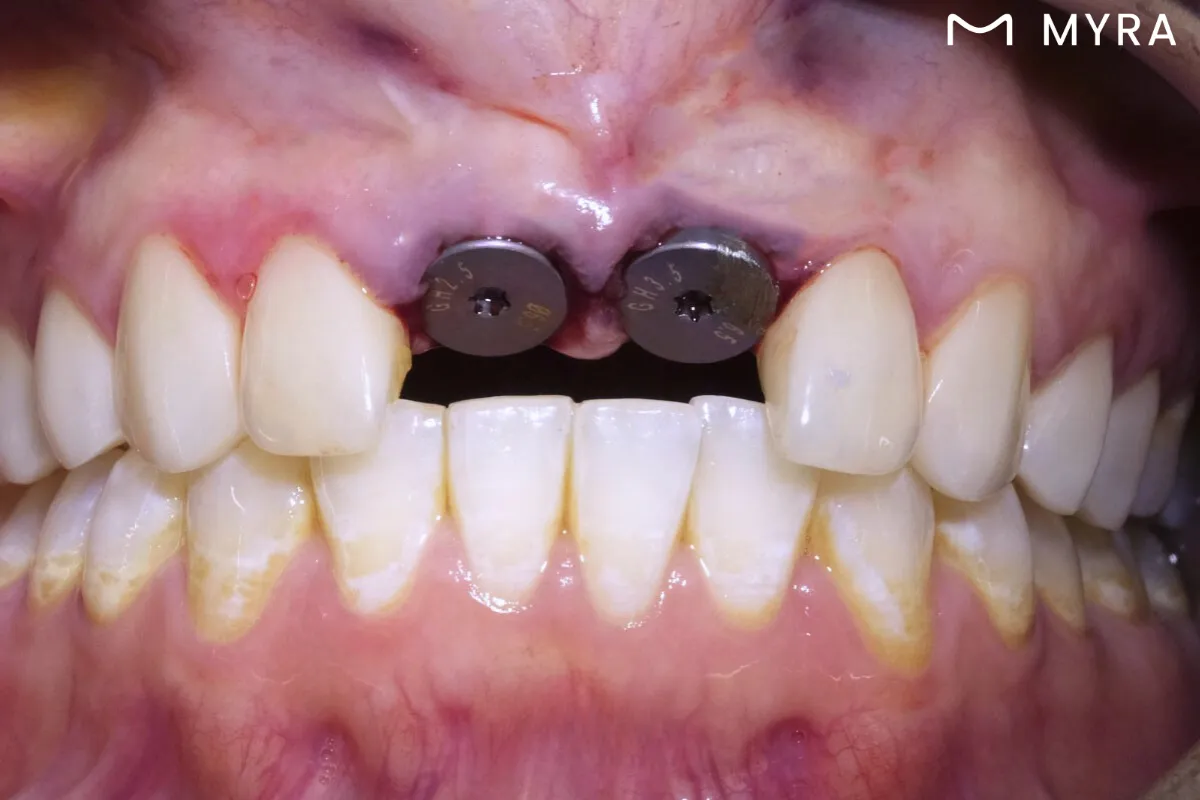 implant-yerlestirme-lokal-anestezi.webp