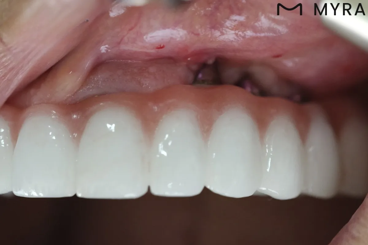 Diş etiyle uyumlu implant üstü porselen kaplamaların ağız içi görünümü