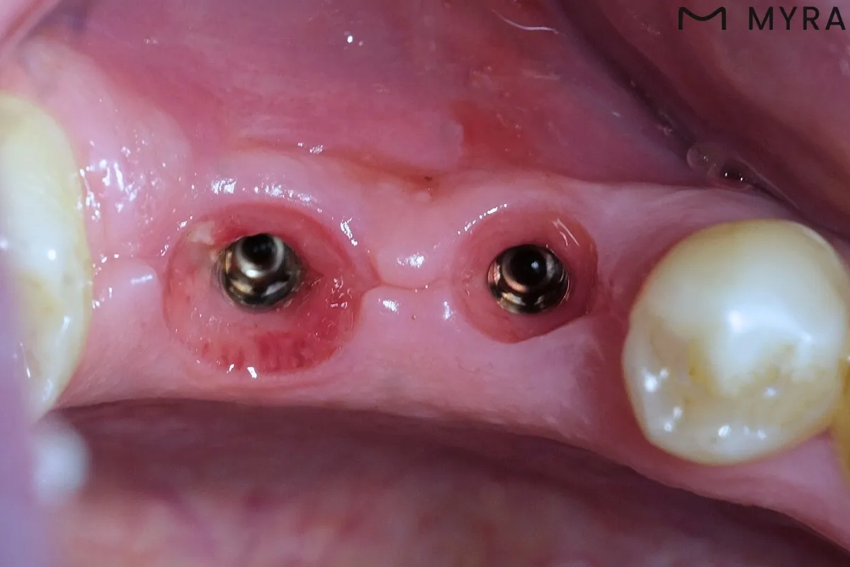 Diş implantının cerrahi olarak yerleştirilmesi süreci. Diş hekimi, implantı çene kemiğine yerleştiriyor.