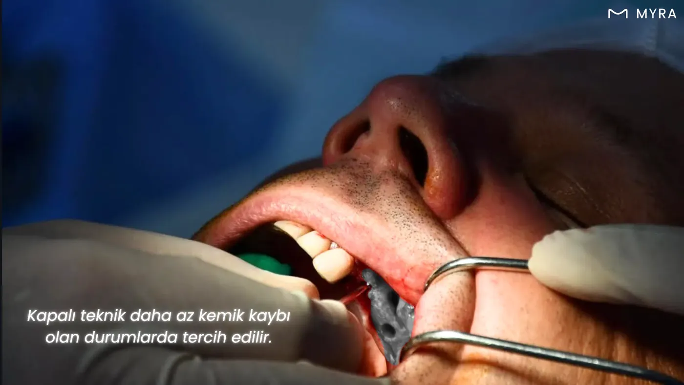 Osteotom yöntemi ile yapılan sinüs lifting işlemi