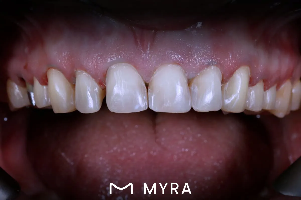 kaplama uygulaması öncesi minimal aşındırılmış ön dişler
