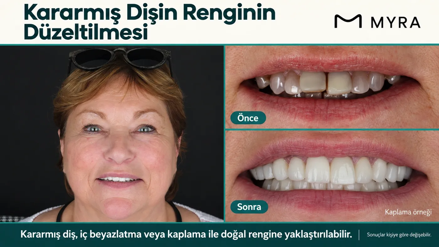 Kanal tedavisi sonrası kararmış dişin iç beyazlatma ile eski rengine dönmesini gösteren öncesi-sonrası görsel