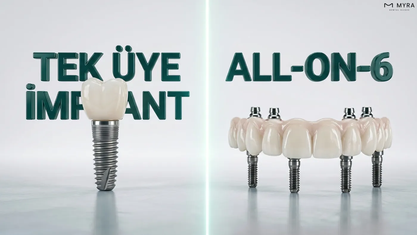 Çoklu implant sistemi ile All-on-6 sistemi farkı