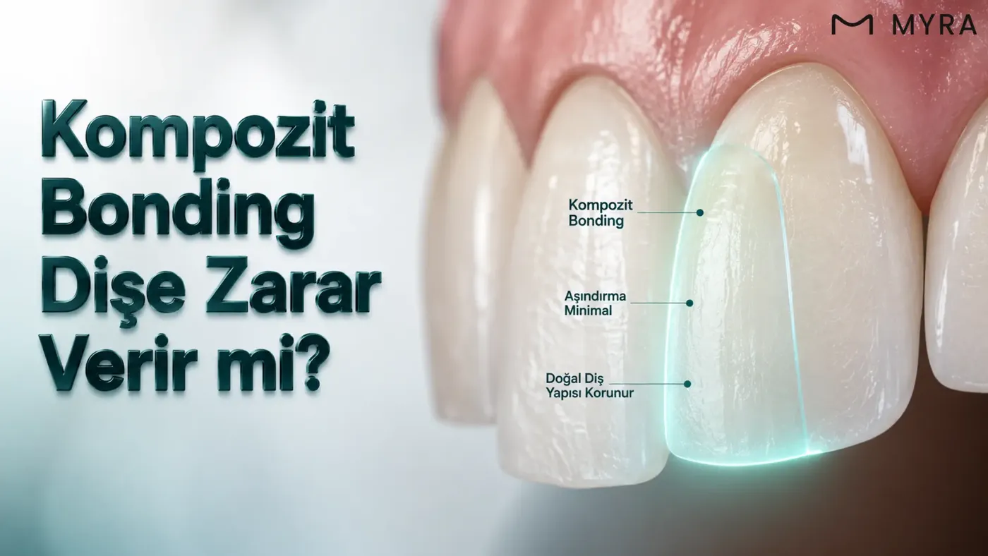 Sağlam mine dokusu korunarak yapılan kompozit bonding uygulamasının şematik gösterimi