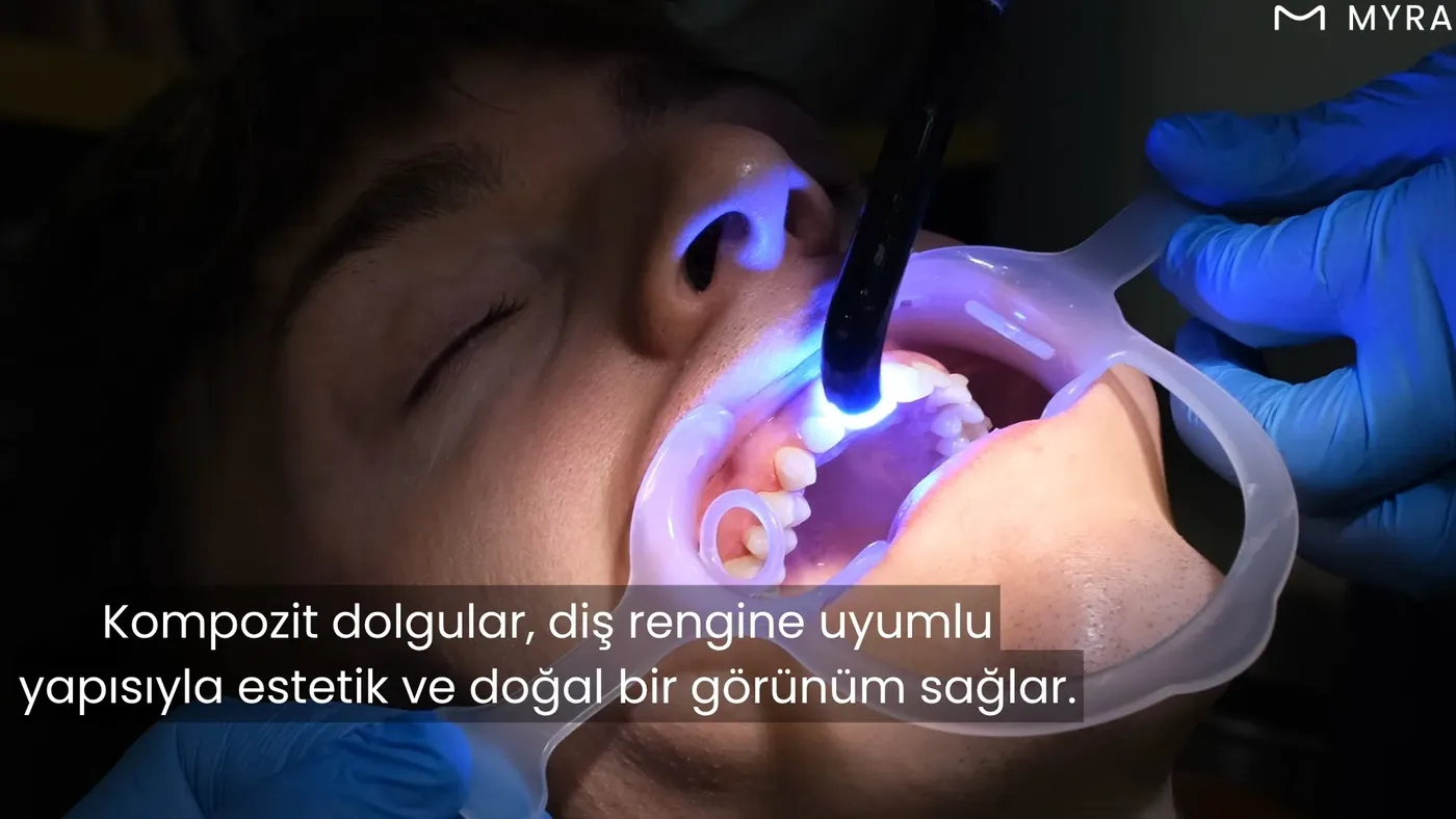 Diş renginde kompozit dolgunun LED ışıkla sertleştirildiği diş tedavisi görseli