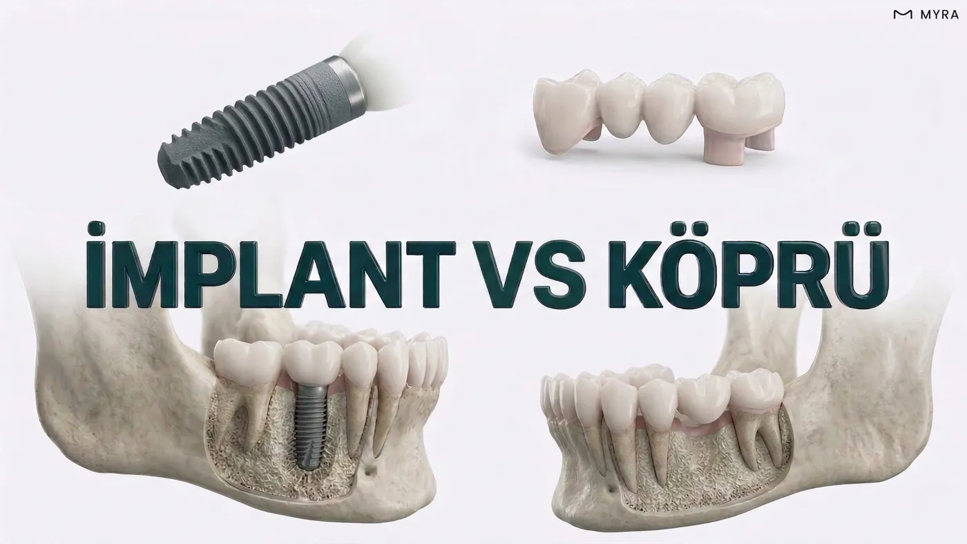 Uzun dönem implant ve köprü kullanımını temsil eden grafiksel karşılaştırma