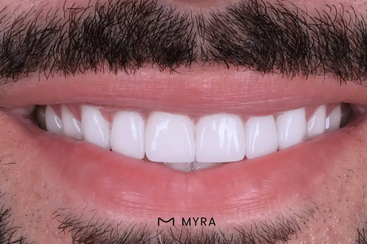 kuron-boyu-uzatma.webp