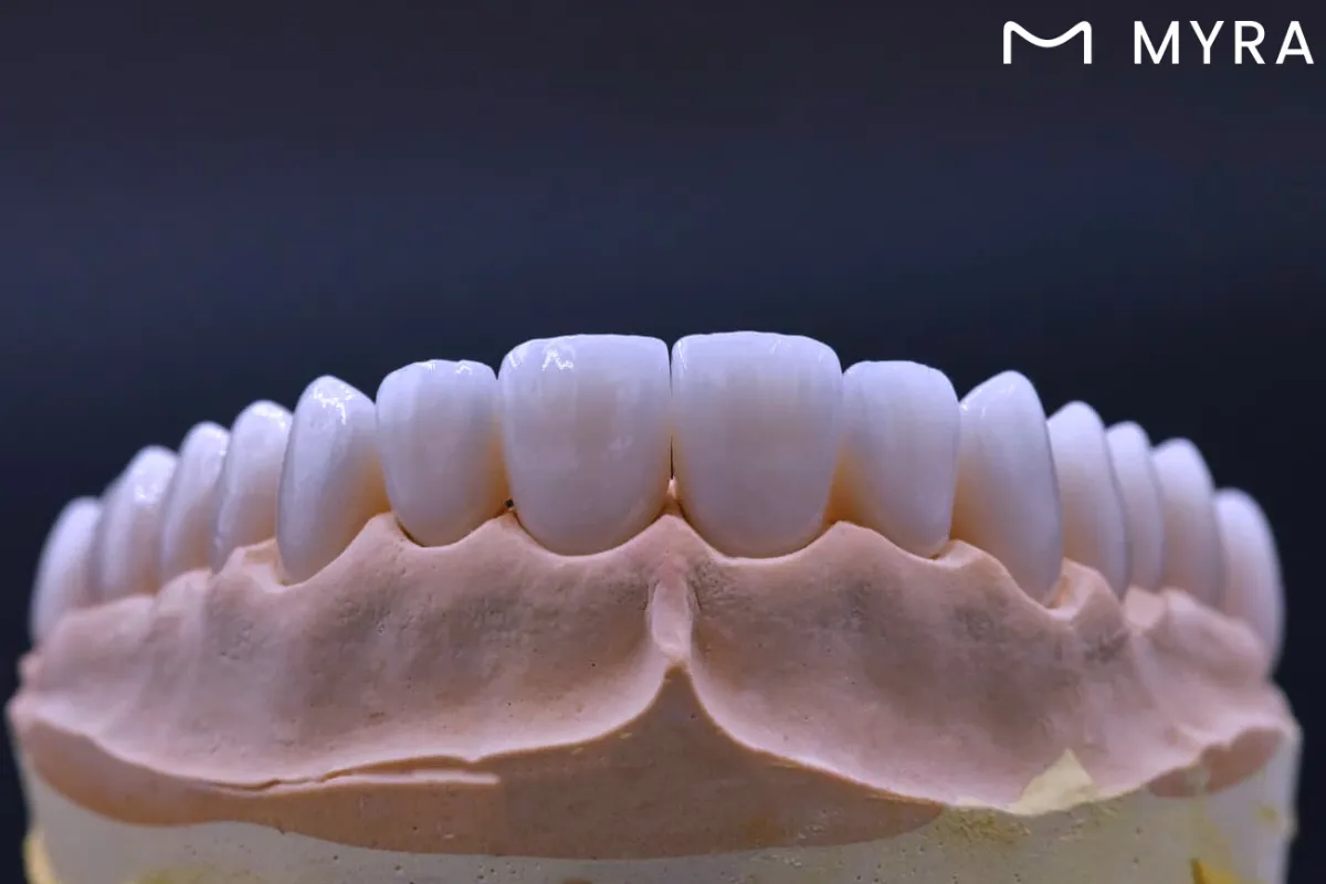 laboratuvar ortamında hazırlanmış lamine diş modeli