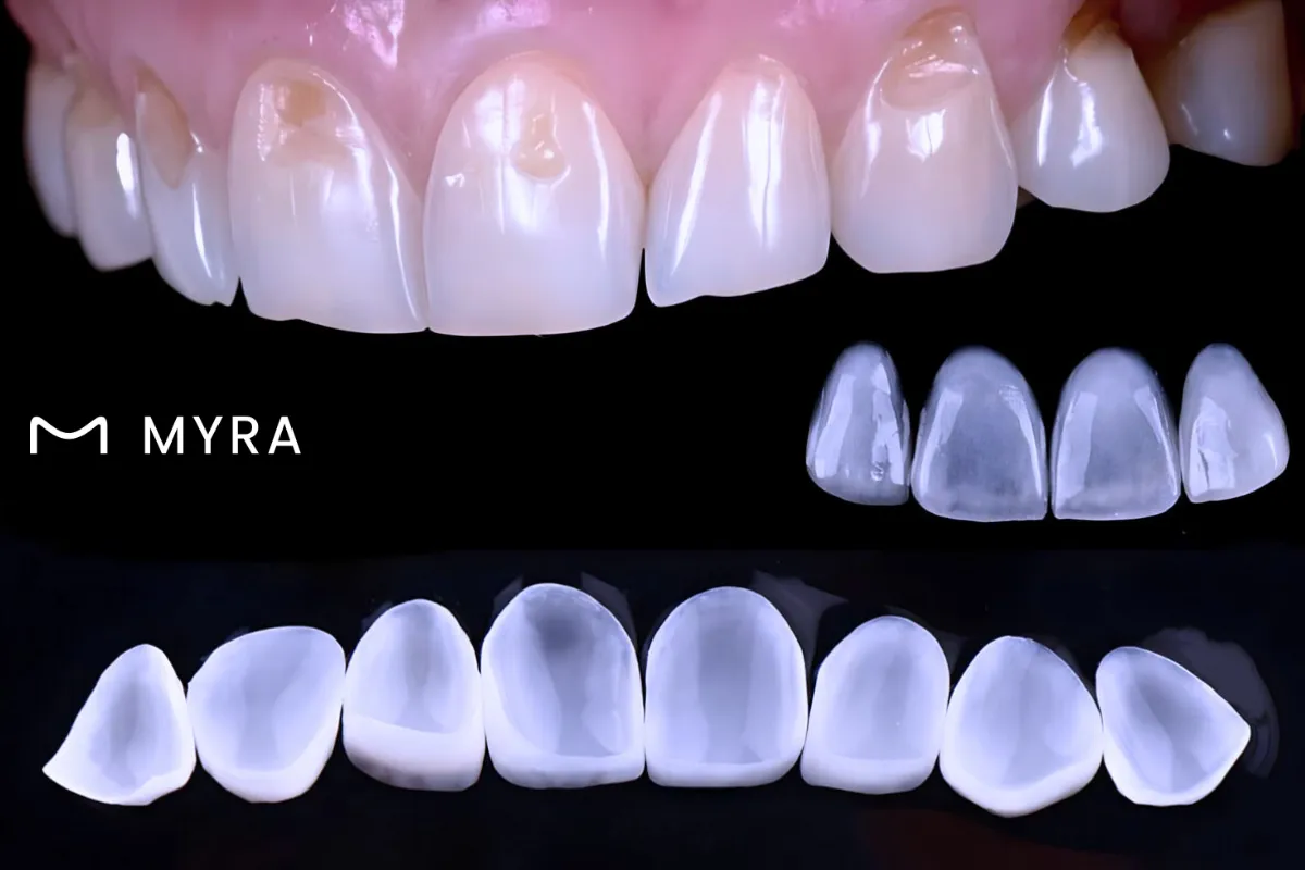 Ultra ince yapısıyla uygulanan Lumineers kaplama modeli
