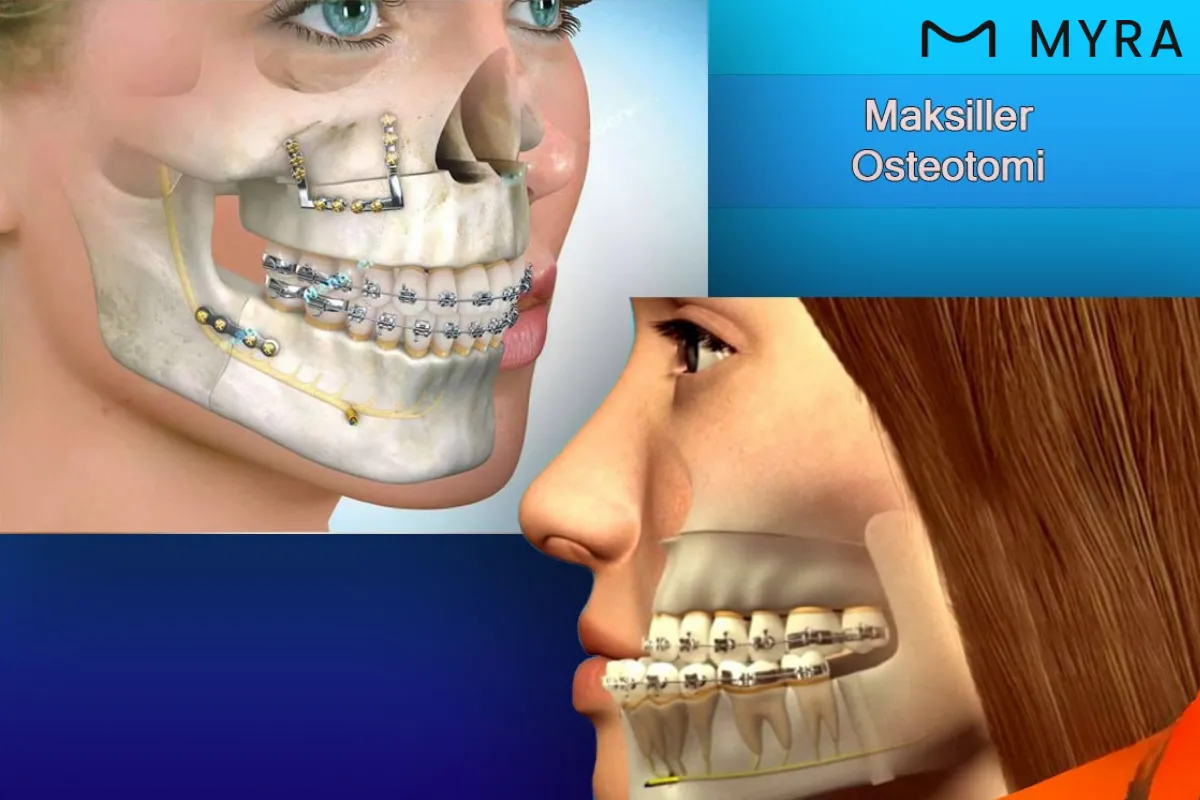 maksiller-osteotomi-cerrahisi.webp