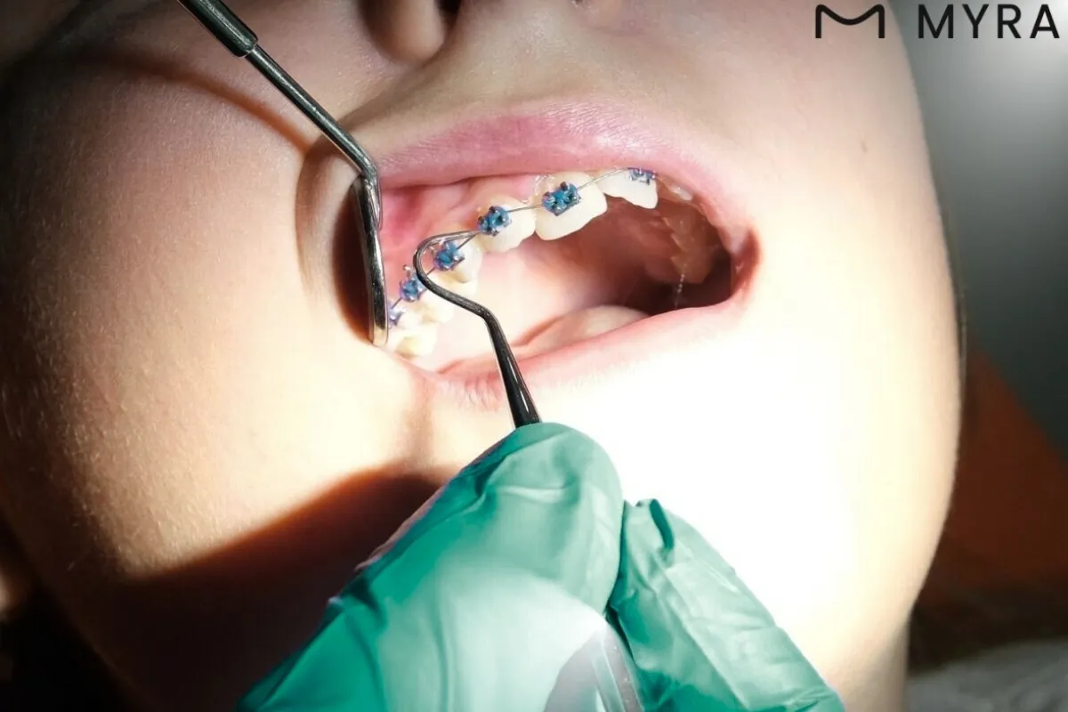  Maloklüzyon Tedavisinde ortodontik braket takılmış hasta