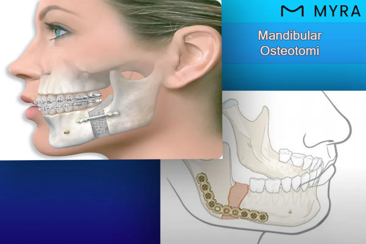 mandibular-osteotomi-alt-cene-duzeltme.webp