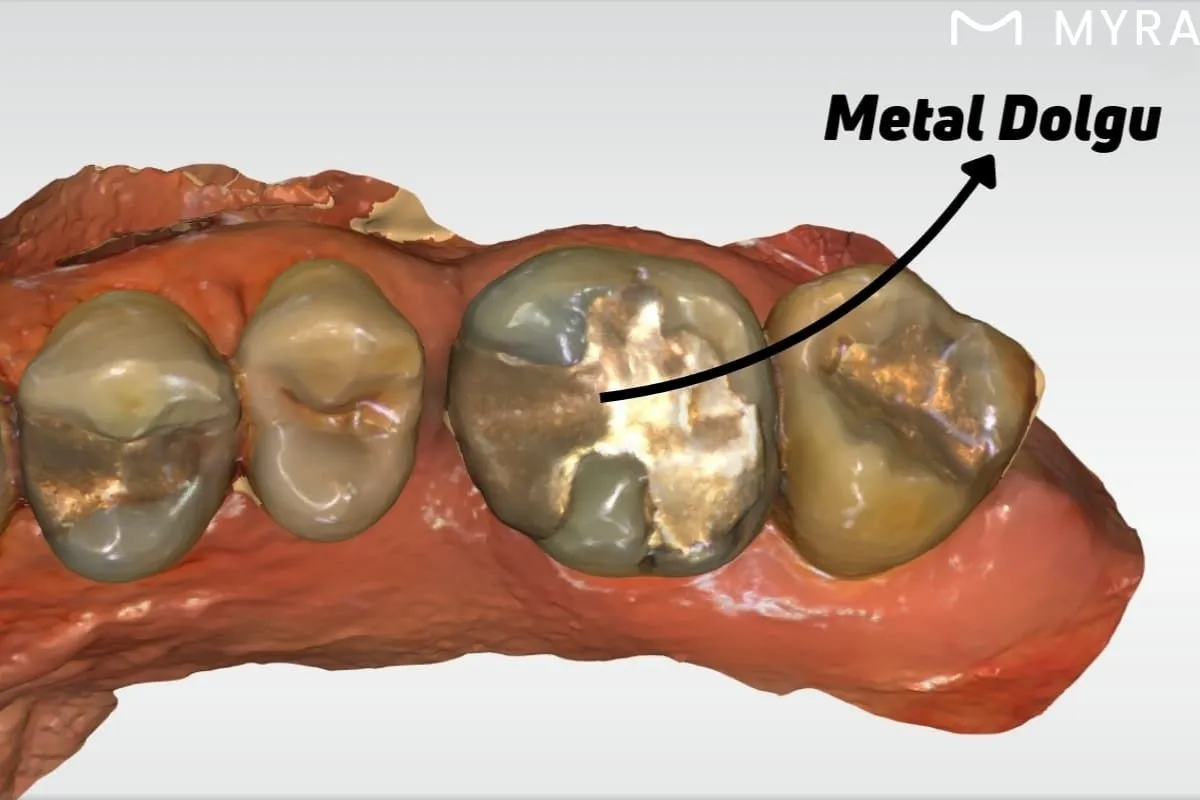 Metal dolgu yapılmış azı dişlerinin yakından görünümü