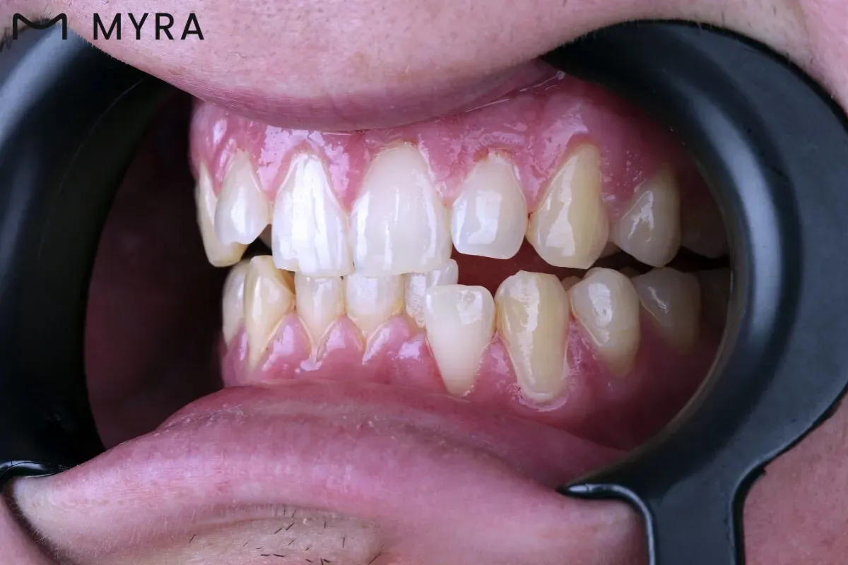 hem ön hem arka diş etleri görünen karma gummy smile tipi