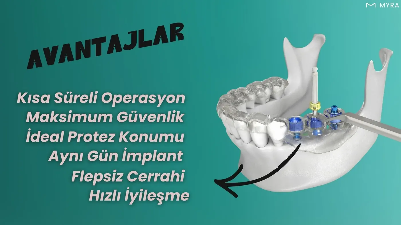 Navigasyonlu implantın güvenlik, hassasiyet ve hızlı iyileşme avantajlarını gösteren diş illüstrasyonu
