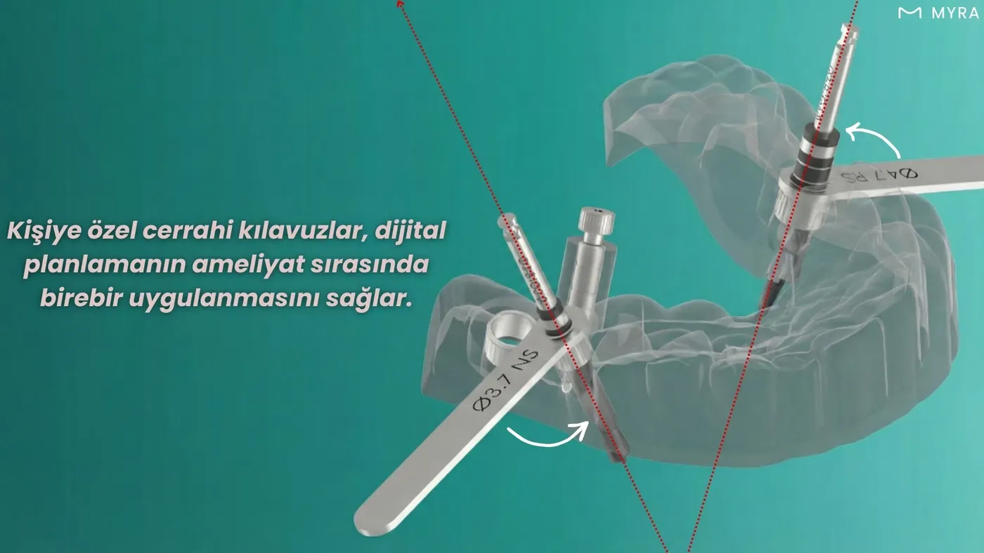 Hastaya özel üretilmiş şeffaf navigasyonlu implant cerrahi kılavuzu (surgical guide)