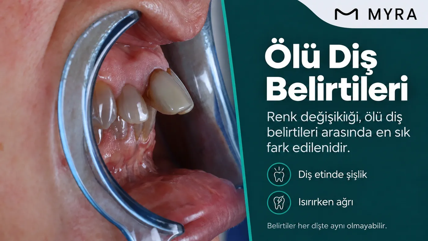 Renk koyulaşması, diş etinde şişlik ve ısırırken ağrı gibi ölü diş belirtilerini gösteren görsel