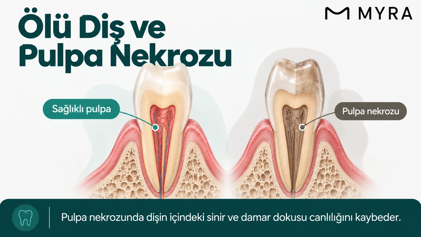 Sağlıklı pulpa ile canlılığını kaybetmiş pulpa dokusunu karşılaştıran diş kesiti