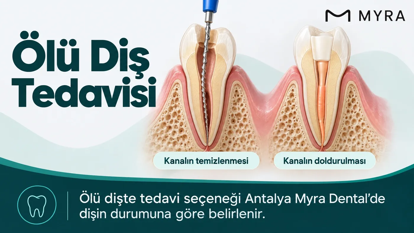 Pulpa nekrozu görülen dişte uygulanan kanal tedavisini gösteren diş kesiti