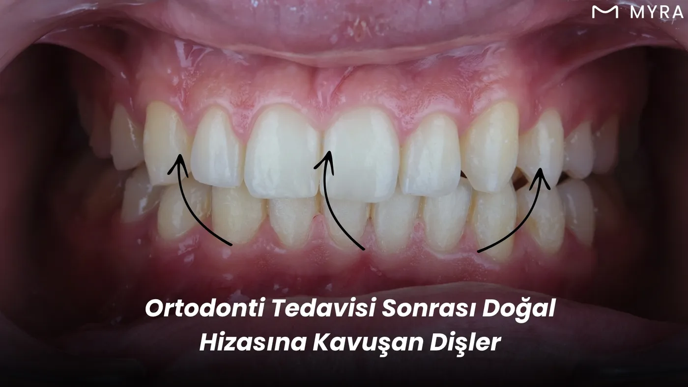Ortodontik tedavi sonrası hizalanmış üst dişler yakından görüntüleniyor