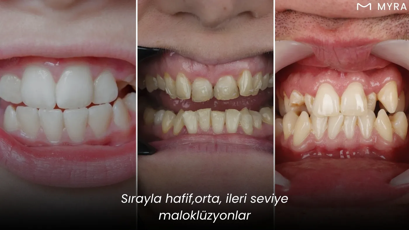 Hafif, orta ve ileri düzey maloklüzyonu karşılaştıran üç aşamalı diş görseli