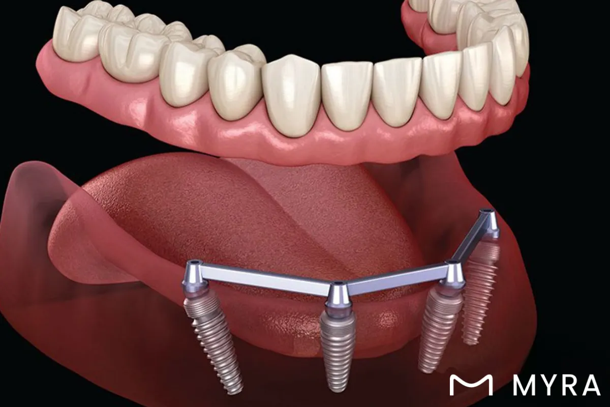 Alt çeneye yerleştirilen implantlarla sabitlenen overdenture protez