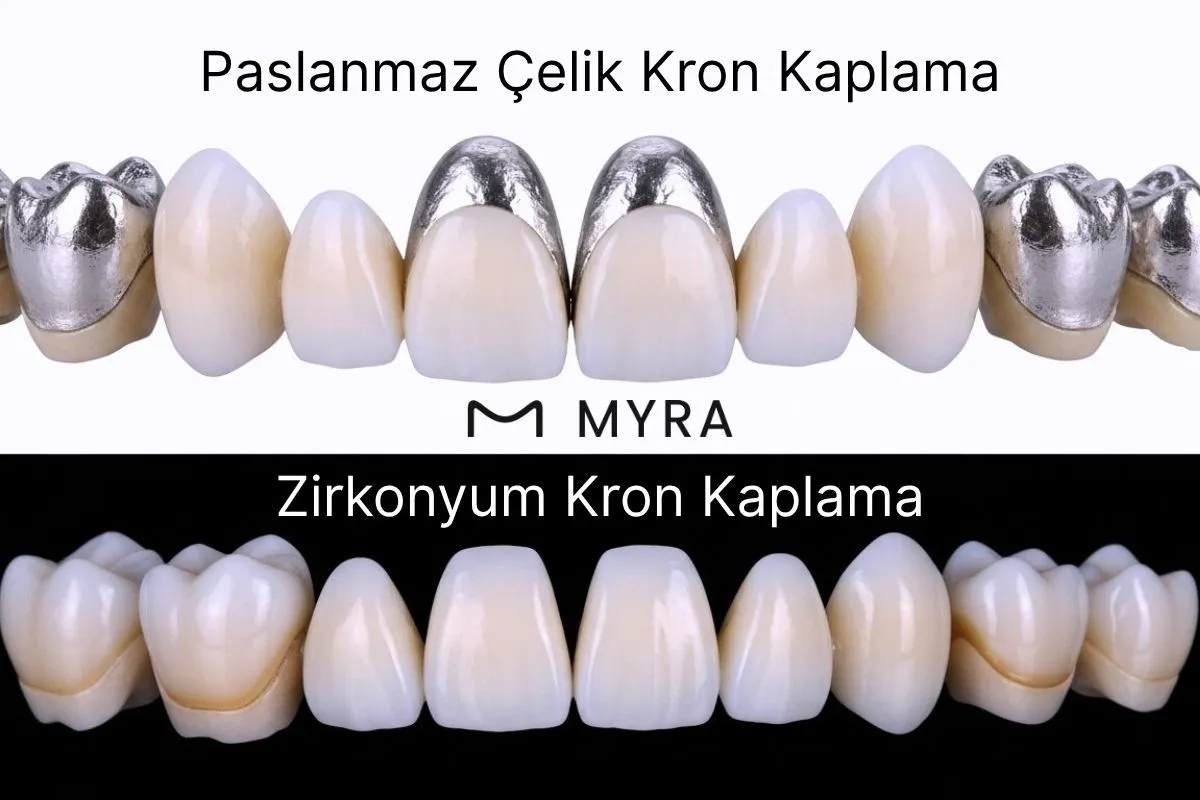 Paslanmaz Çelik ve Zirkonyum Kron Karşılaştırması
