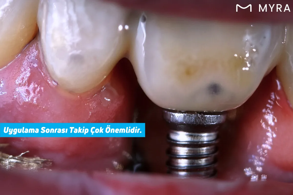 Diş implantı çevresinde gelişen periimplantitis enfeksiyonu