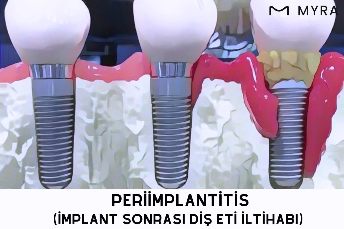 İmplant çevresindeki iltihaplanmayı gösteren şematik görsel
