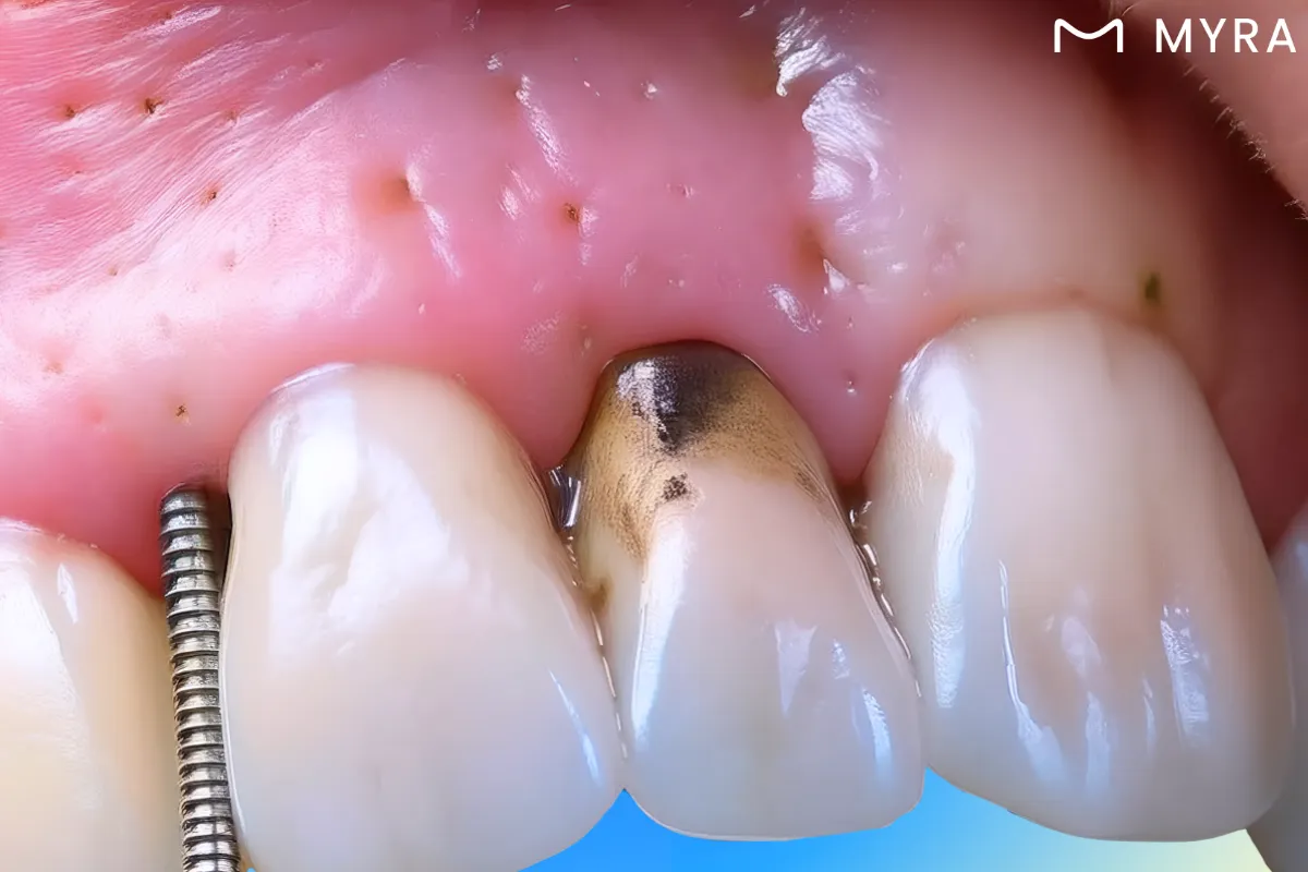 İltihaplı implant bölgesinde gözle görülür kızarıklık ve kabarma