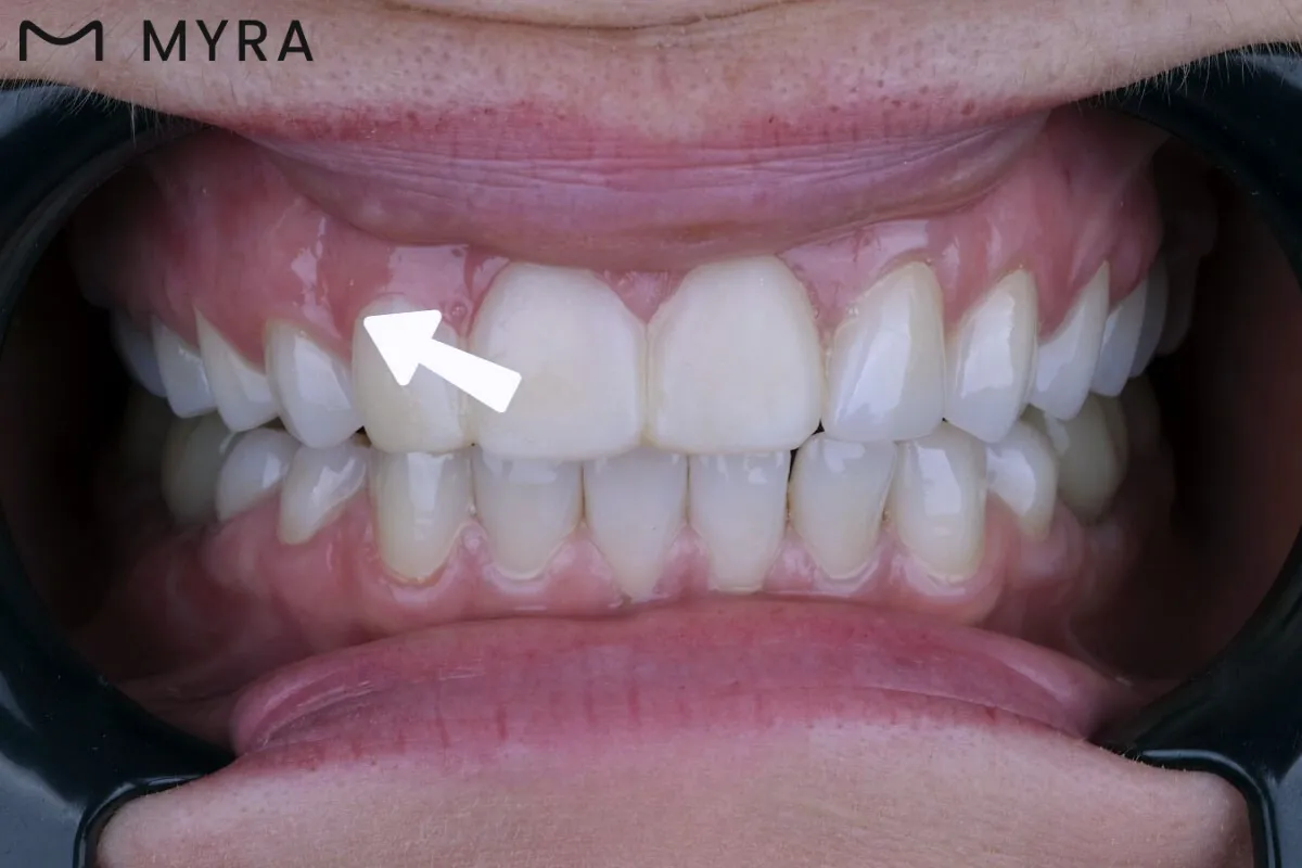 arka dişlerde görülen diş eti fazlalığı gummy smile durumu