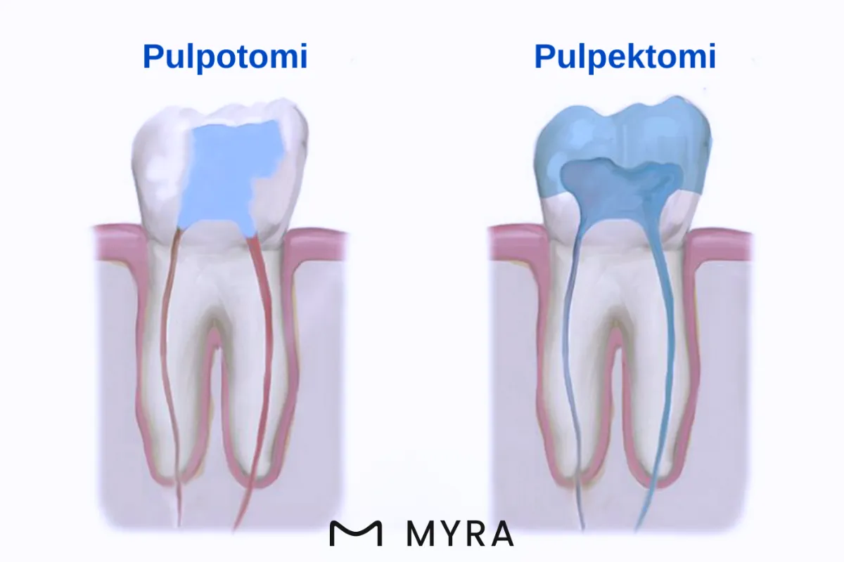 Pulpotomi ve pulpektomi işlemlerini karşılaştıran çizim