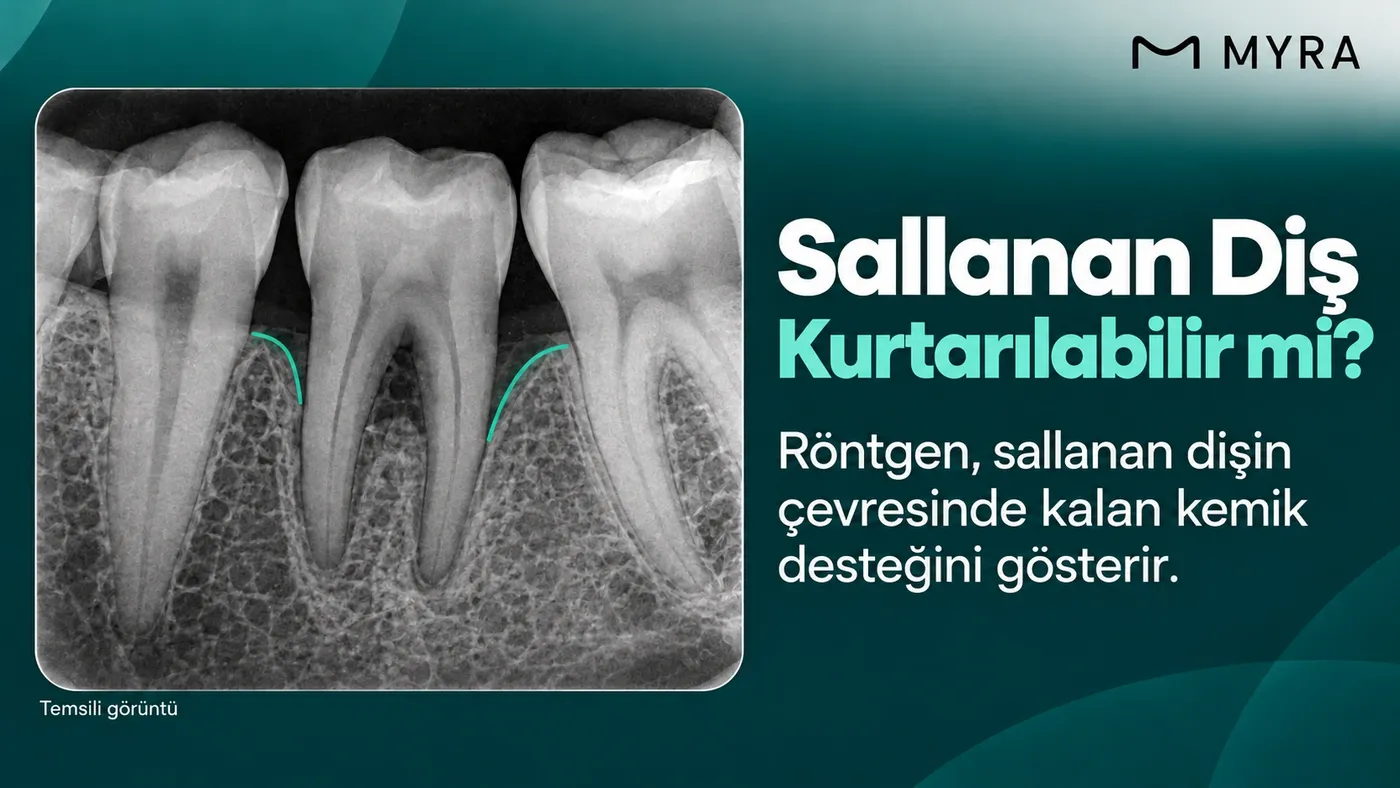 Sallanan dişin kemik desteğini gösteren diş röntgeni
