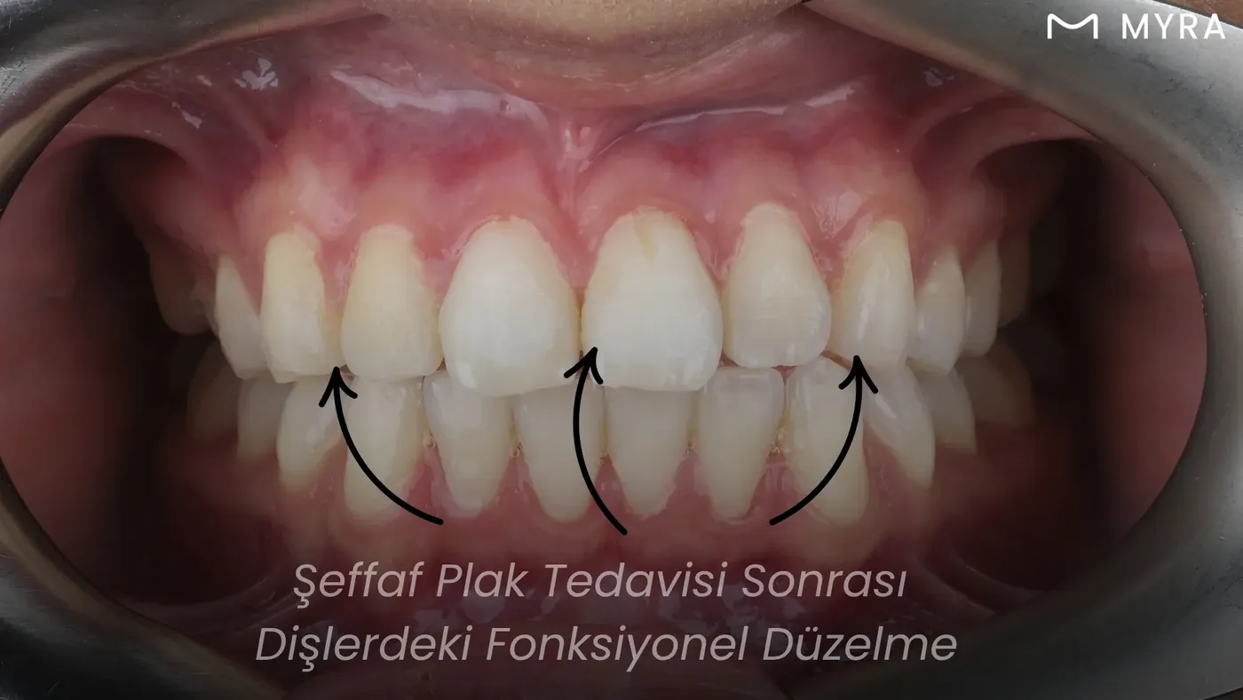 Şeffaf plak tedavisi sonrası düzgün hizalanmış, estetik gülümsemeye sahip dişler