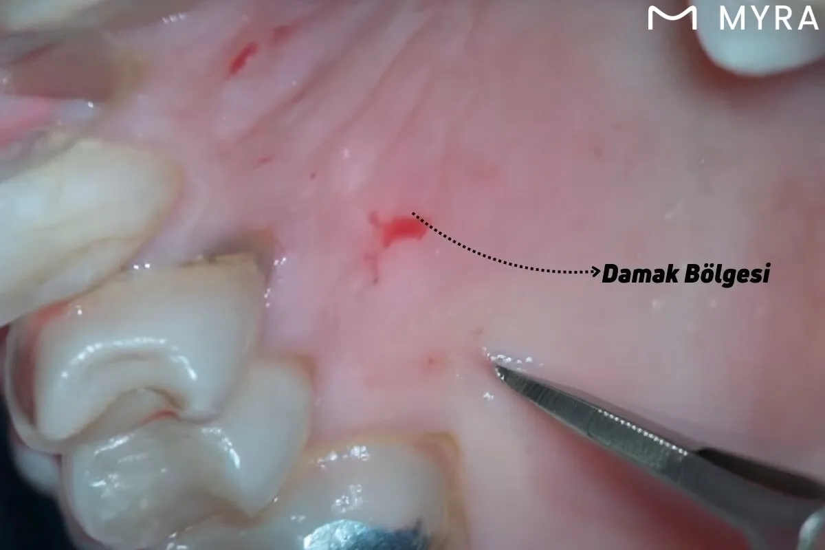Serbest diş eti grefti, diş eti çekilmesi tedavisinde damaktan alınan doku ile uygulanan bir yöntemdir.
