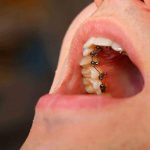 , Yetişkinlerde Ortodonti Tedavisi