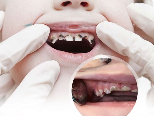 , Çocuk Ağız ve Diş Sağlığı (Pedodonti) Sıkça Sorulan Sorular