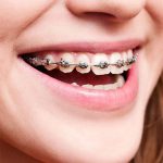 , Yetişkinlerde Ortodonti Tedavisi